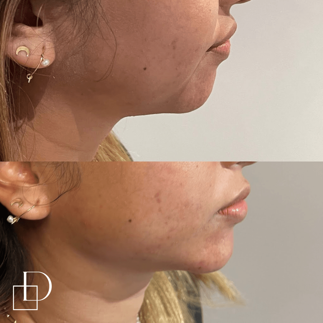 Before and after jawline filler injections at Define Clinic Brisbane
