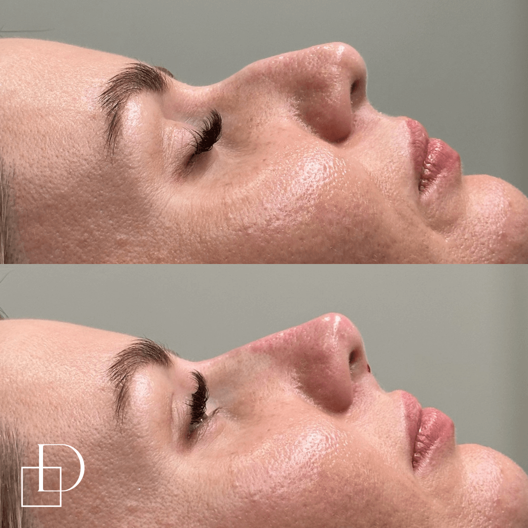 Before and after non-surgical rhinoplasty nose filler at Define Clinic Brisbane