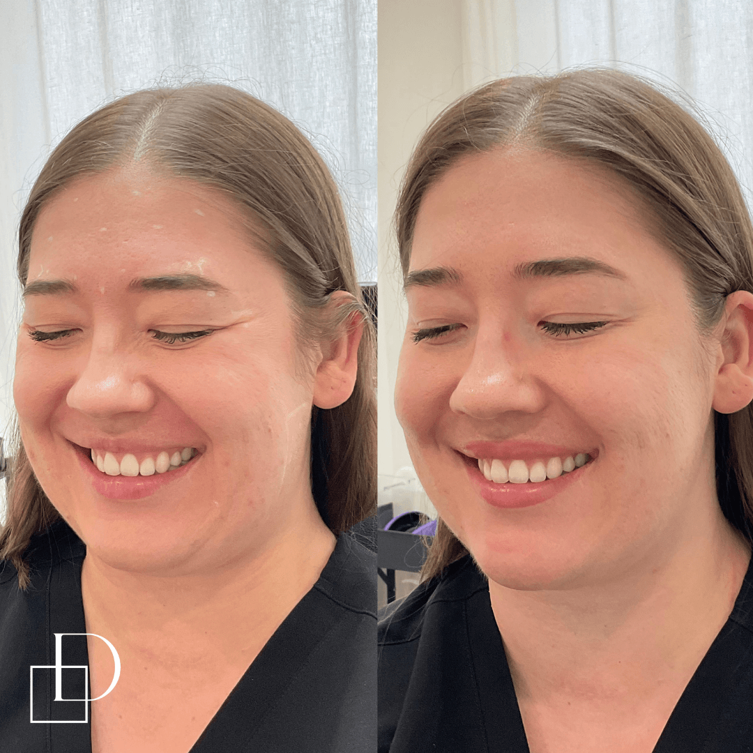 Before and after botox anti-wrinkle at Define Clinic Brisbane