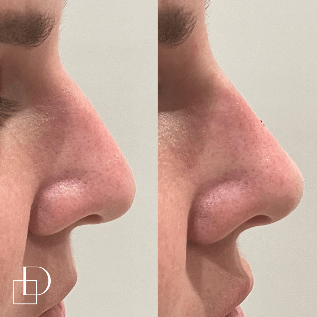 Before and after non-surgical rhinoplasty nose filler at Define Clinic Brisbane