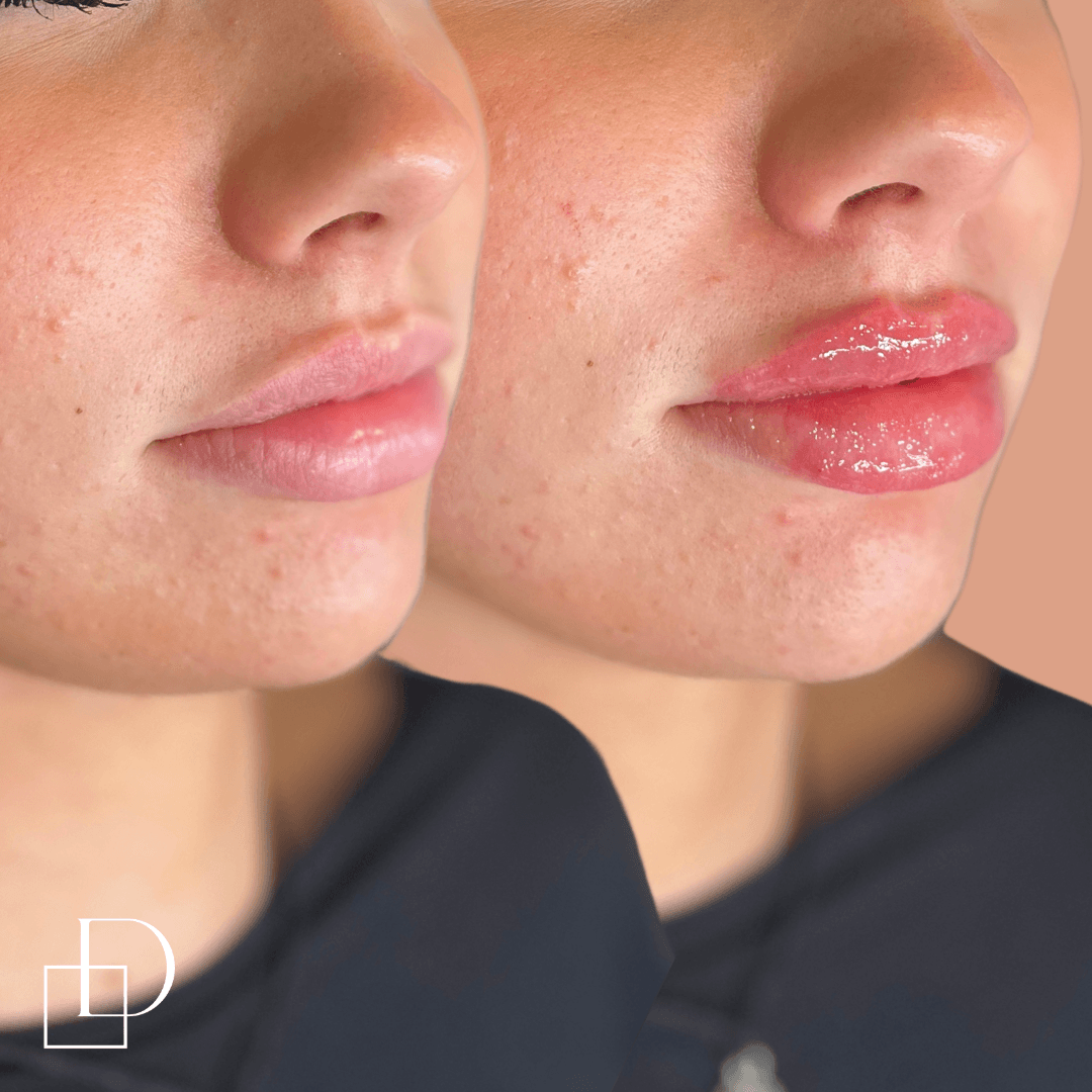 Before and after lip filler injections at Define Clinic Brisbane