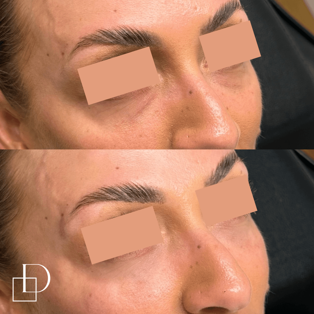 Before and after tear trough under eye filler injections at Define Clinic Brisbane