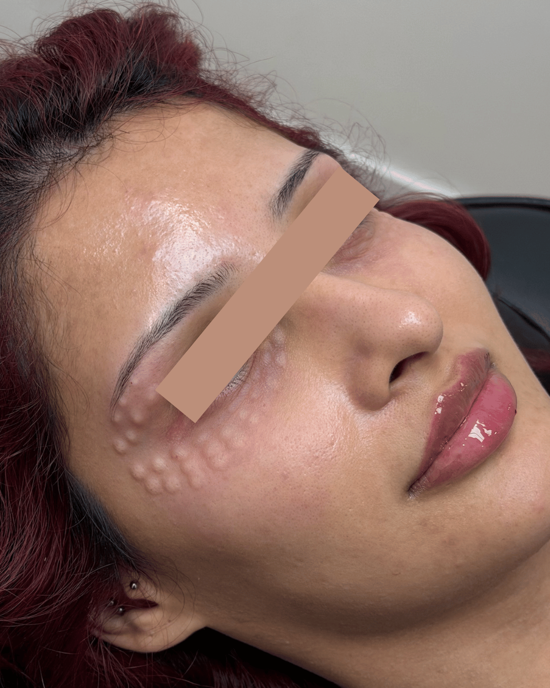 Skin appearance after rejuran i under eye treatment.