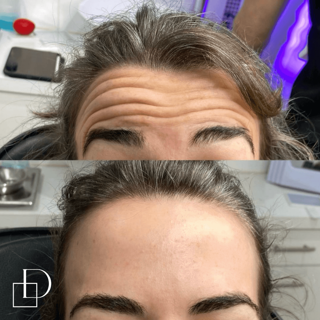 Before and after forehead botox anti-wrinkle at Define Clinic Brisbane