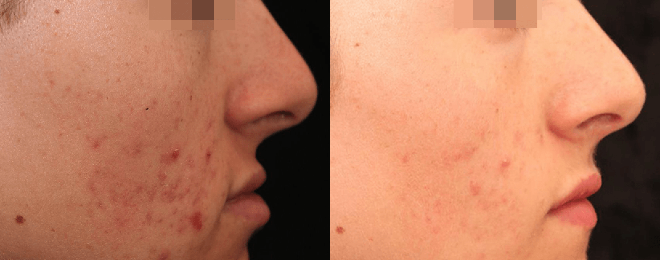 Before and after acne treatment with Laser Genesis at Define Clinic Brisbane