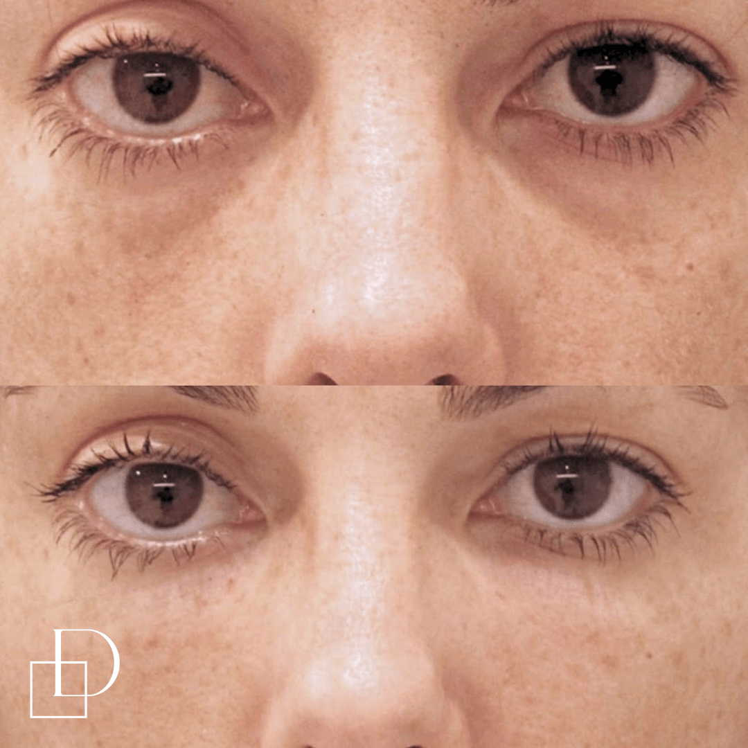 Before and after tear trough under eye filler injections at Define Clinic Brisbane