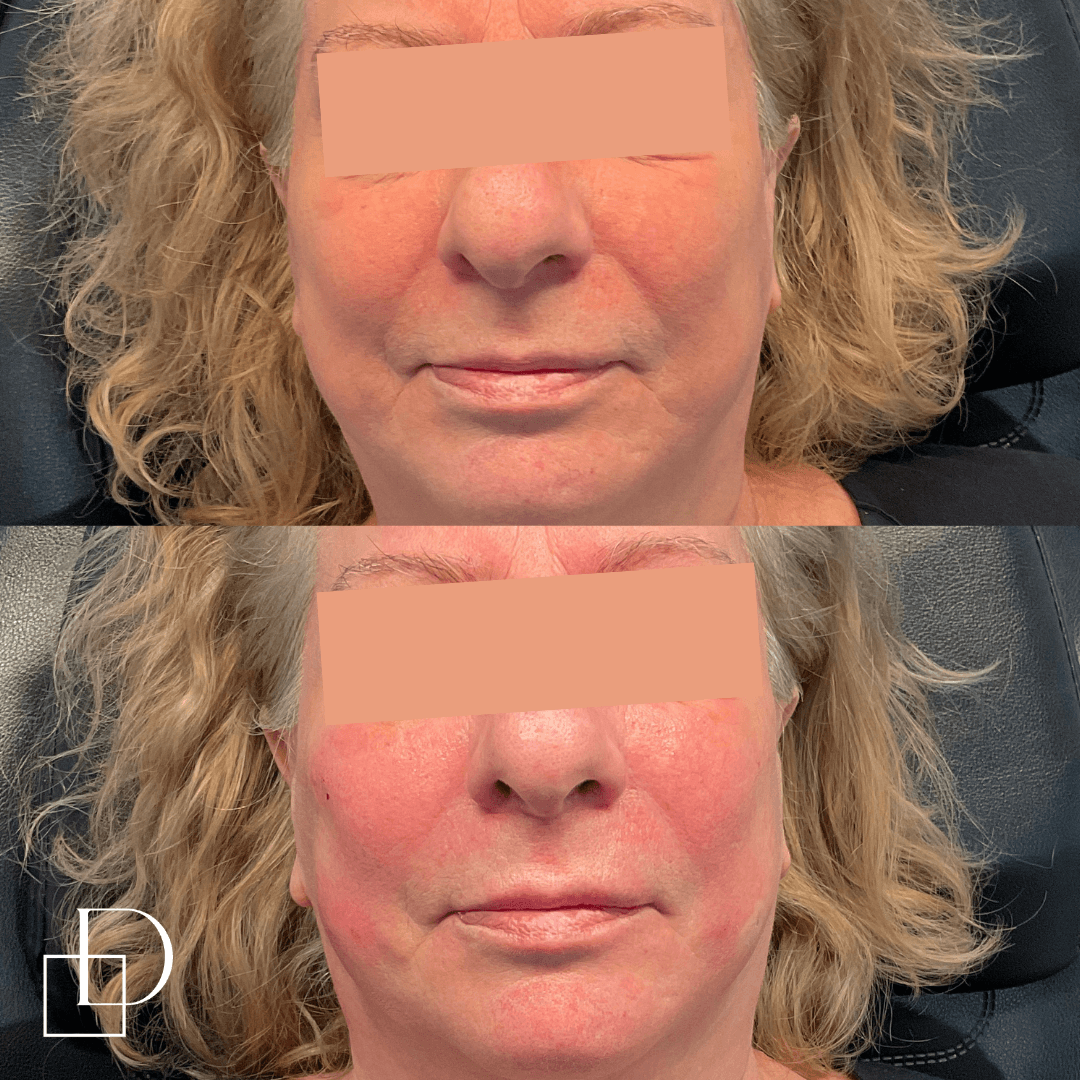 Before and after cheek filler injections at Define Clinic Brisbane