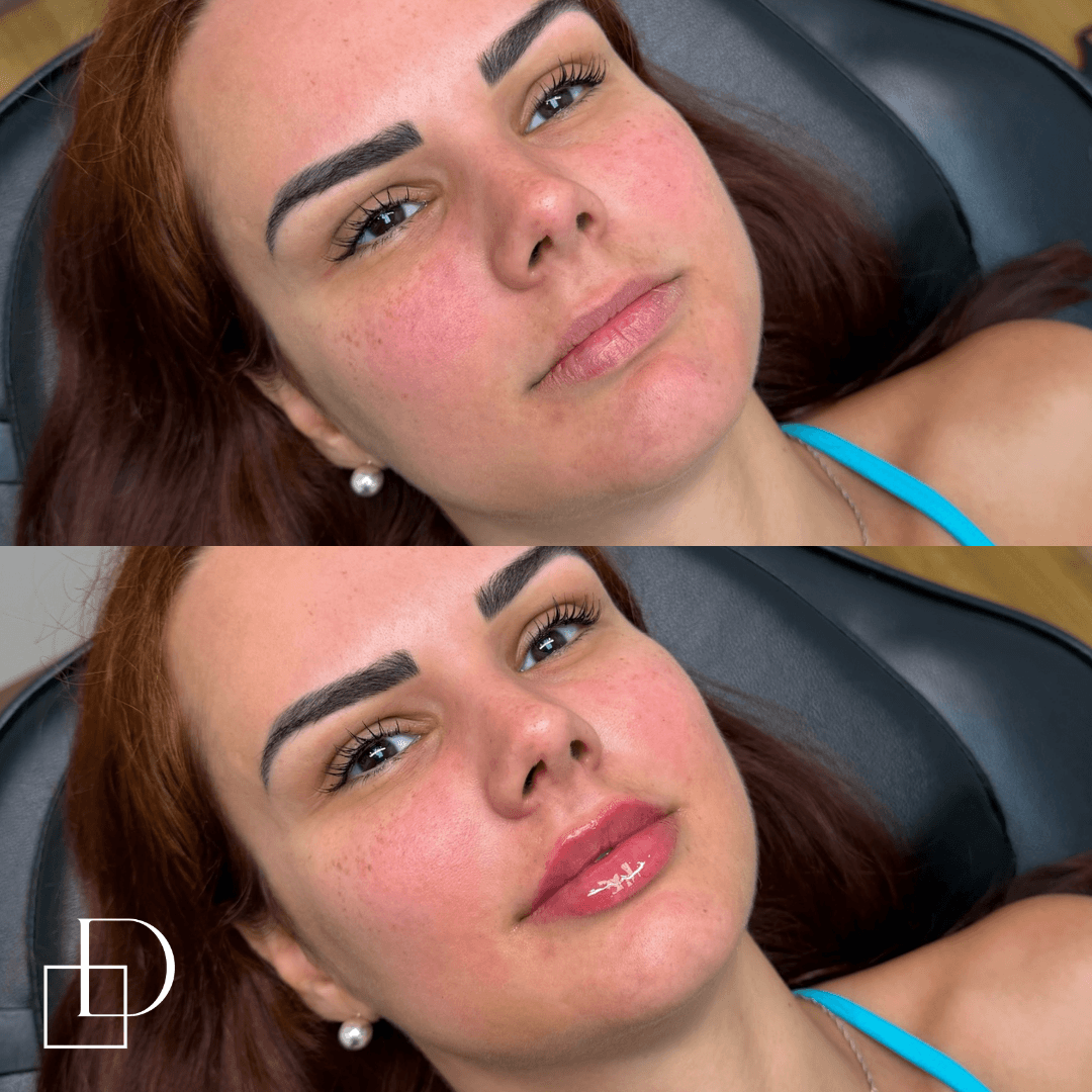 Before and after lip filler injections at Define Clinic Brisbane