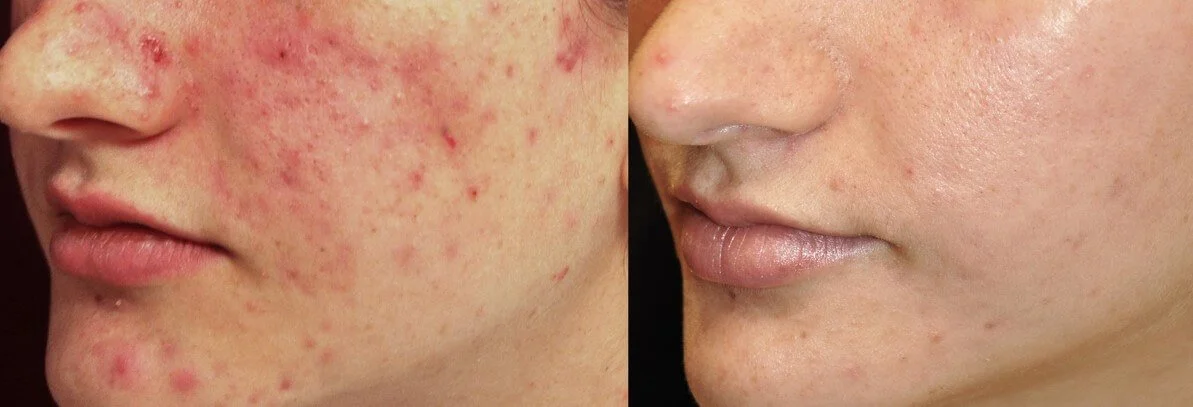 Before and after acne treatment with Laser Genesis at Define Clinic Brisbane