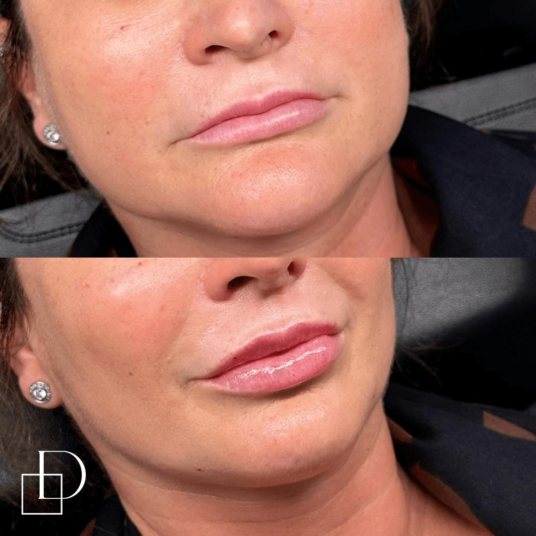 Before and after cosmetic dermal filler injections at Define Clinic Brisbane