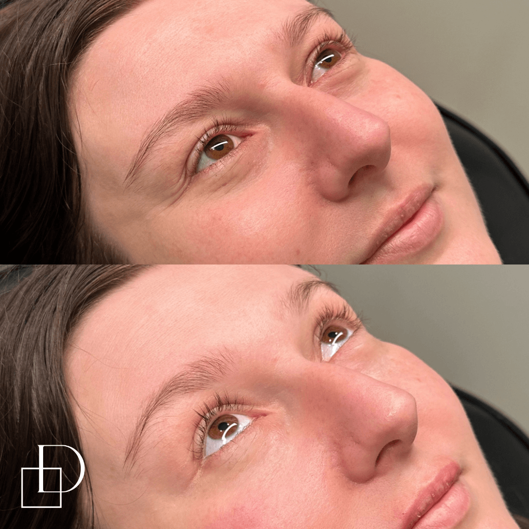 Before and after tear trough under eye filler injections at Define Clinic Brisbane