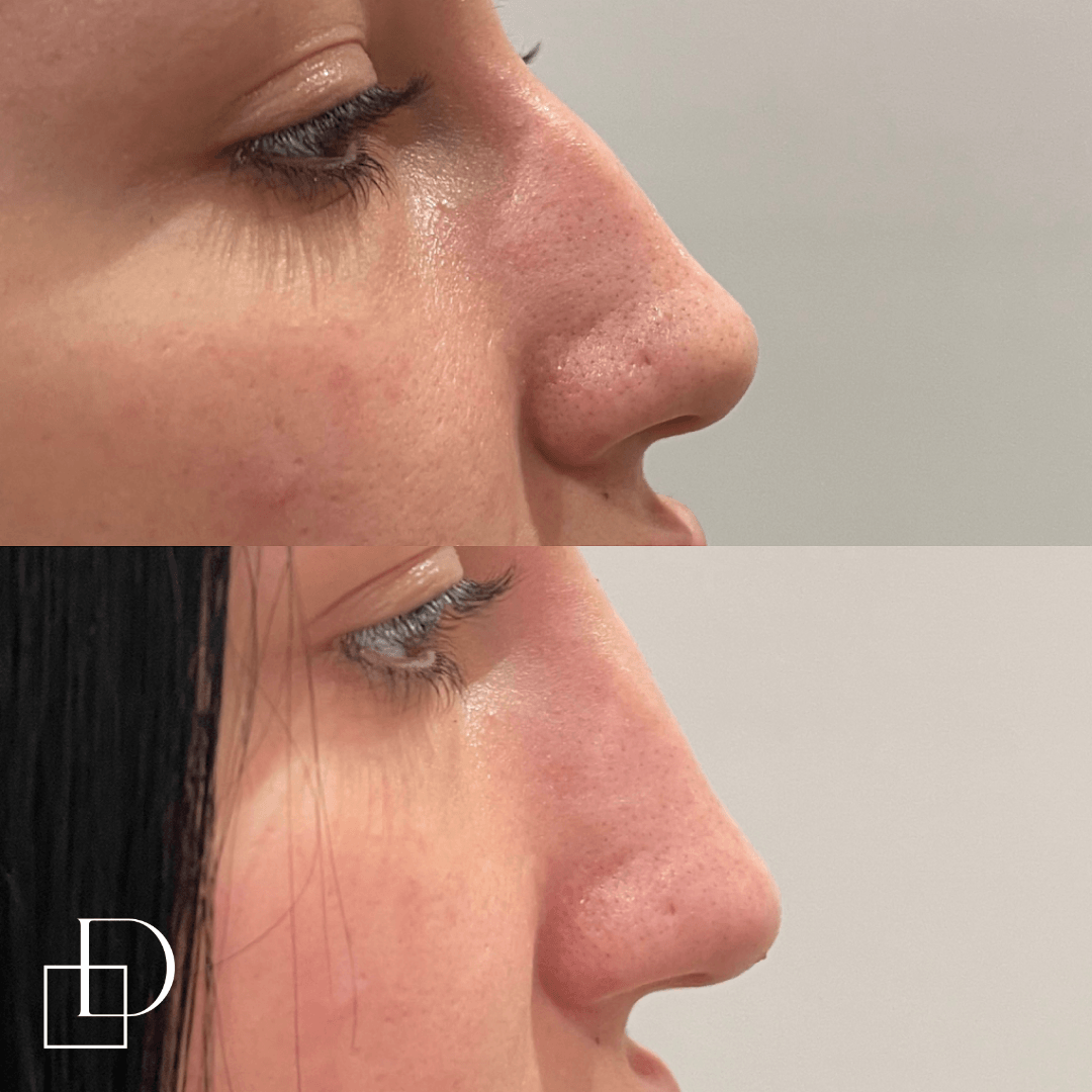 Before and after non-surgical rhinoplasty nose filler at Define Clinic Brisbane