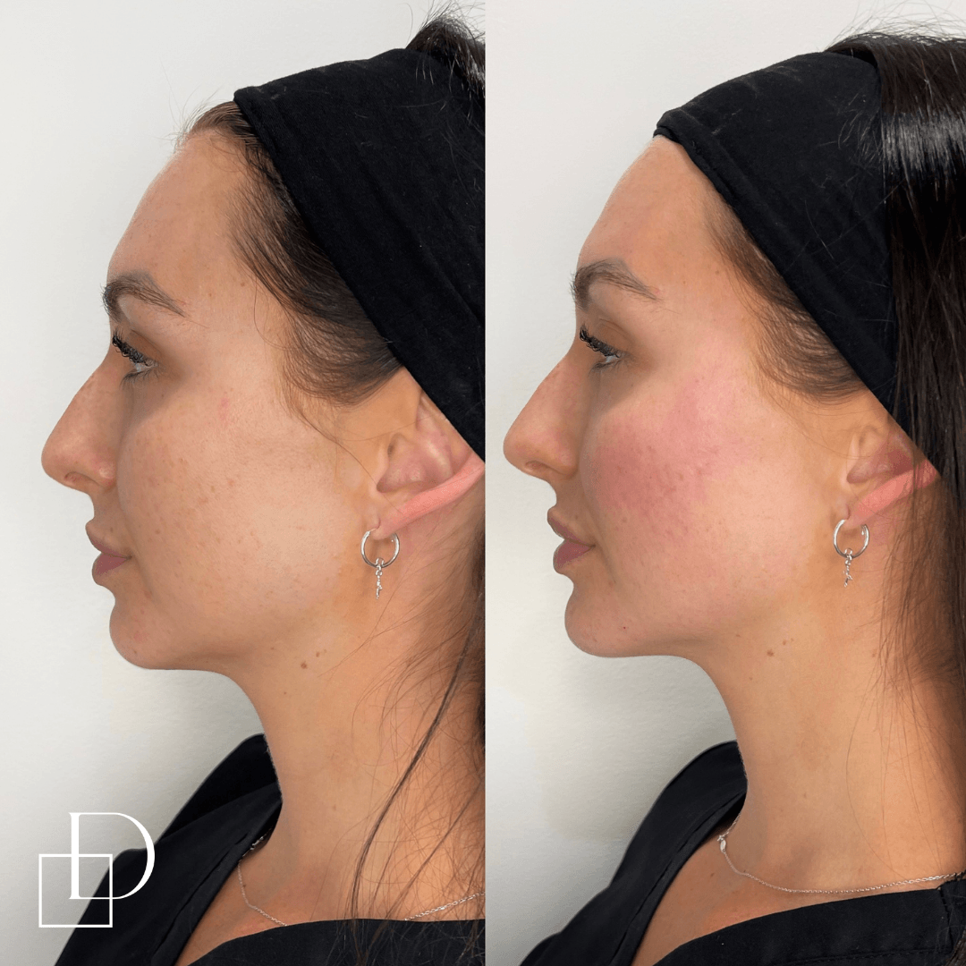 Before and after cheek filler injections at Define Clinic Brisbane