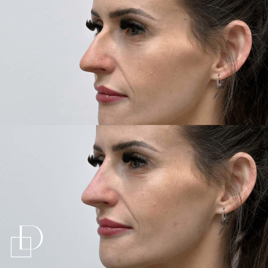 Before and after non-surgical rhinoplasty nose filler at Define Clinic Brisbane