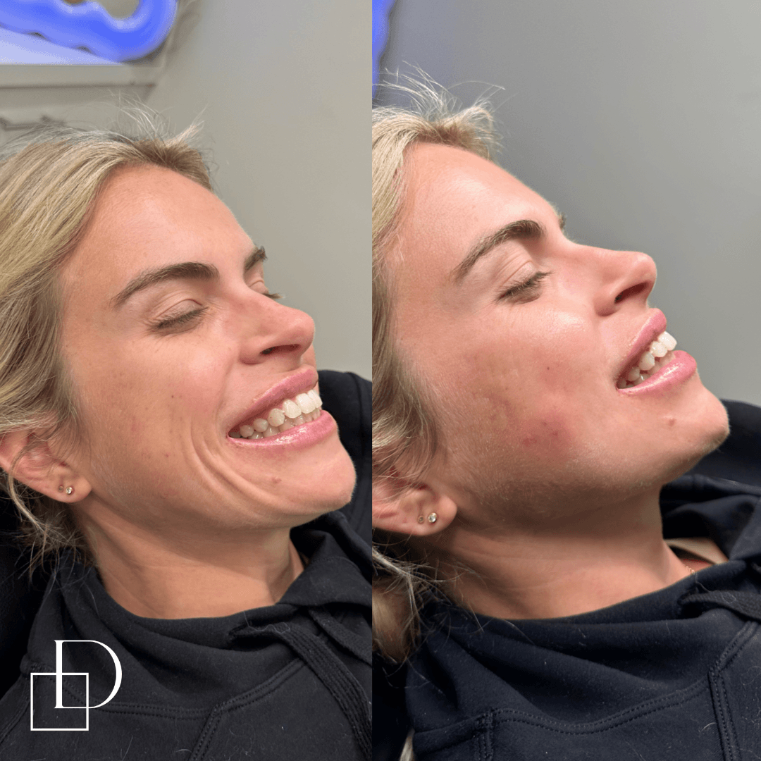 Before and after cosmetic dermal filler injections at Define Clinic Brisbane