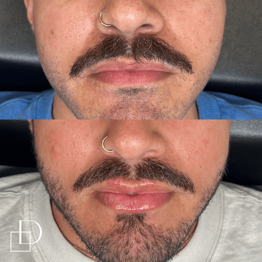 Before and after lip filler injections on a male patient at Define Clinic Brisbane