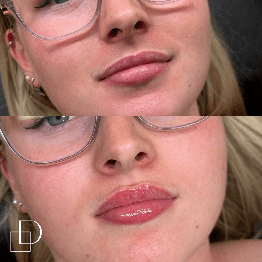 Before and after lip filler injections at Define Clinic Brisbane