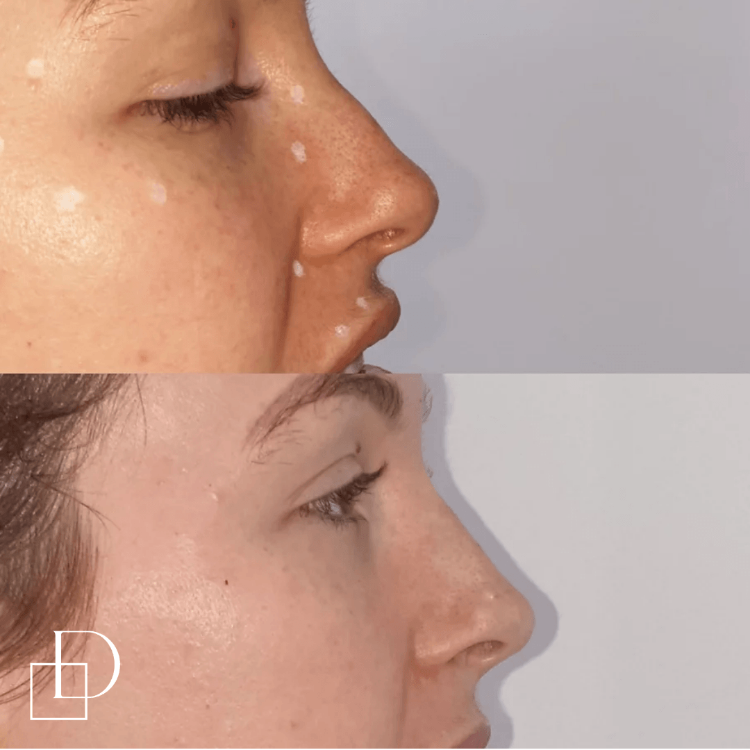 Before and after non-surgical rhinoplasty nose filler at Define Clinic Brisbane