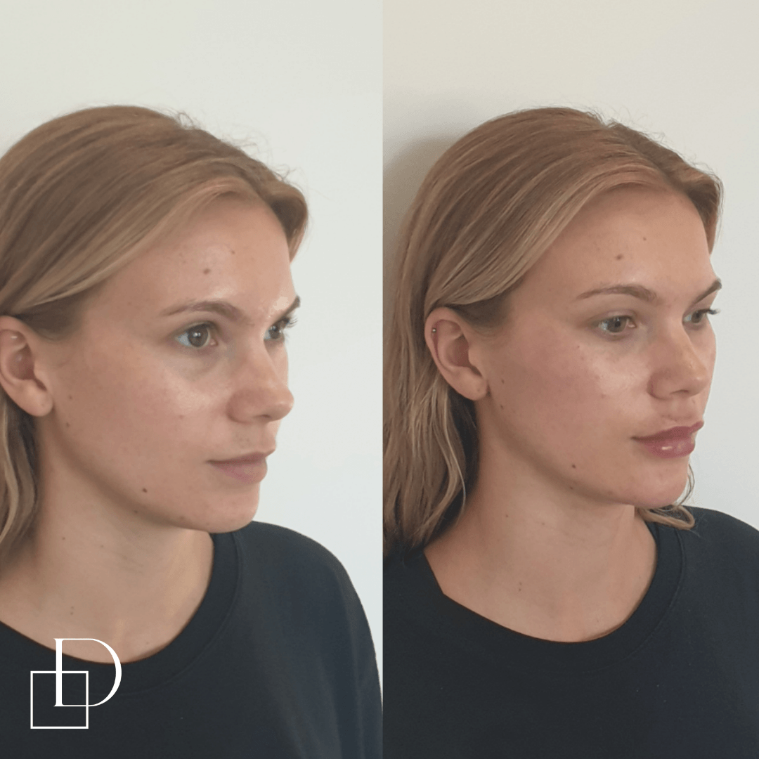 Before and after chin filler injections at Define Clinic Brisbane