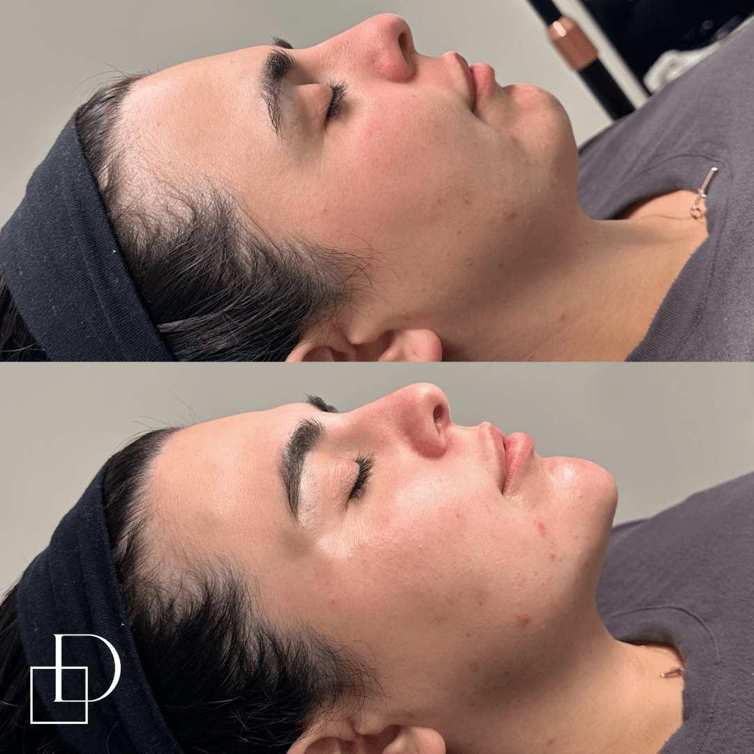 Before and after chin filler injections at Define Clinic Brisbane