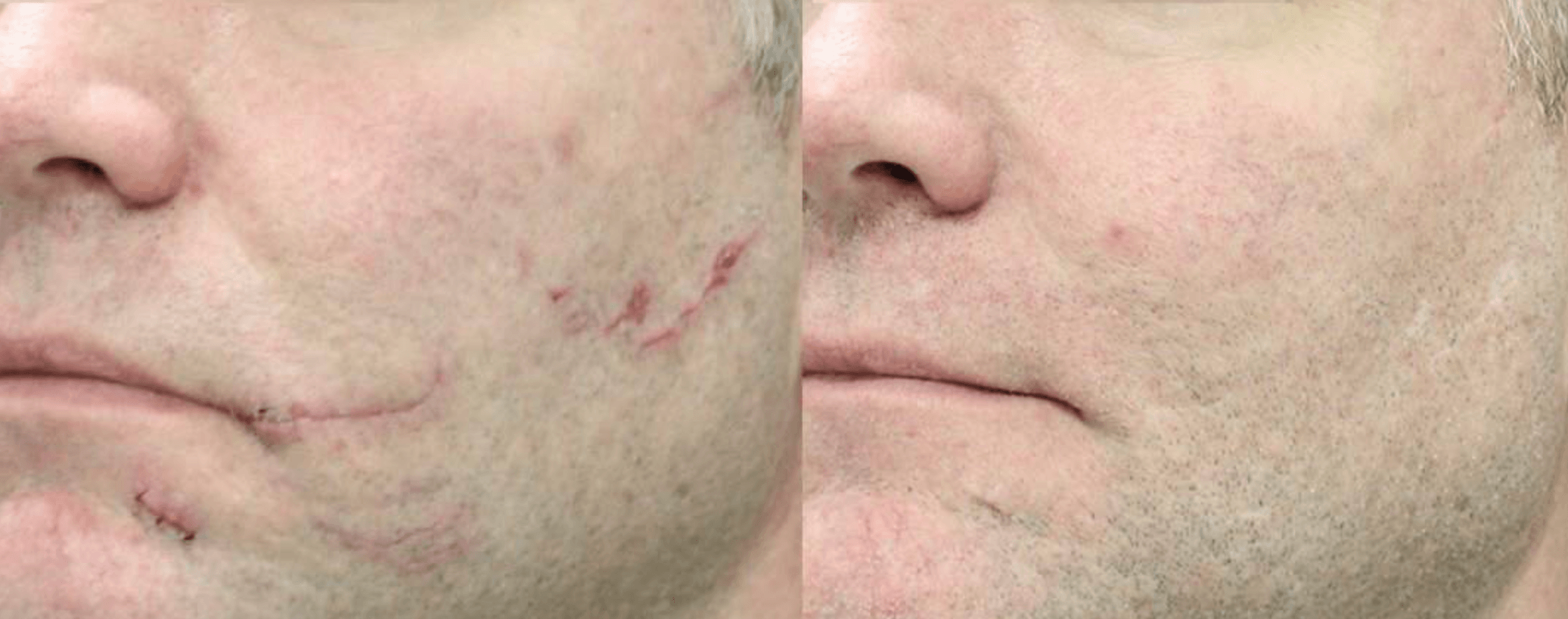 Before and after scar treatment with Laser Genesis at Define Clinic Brisbane