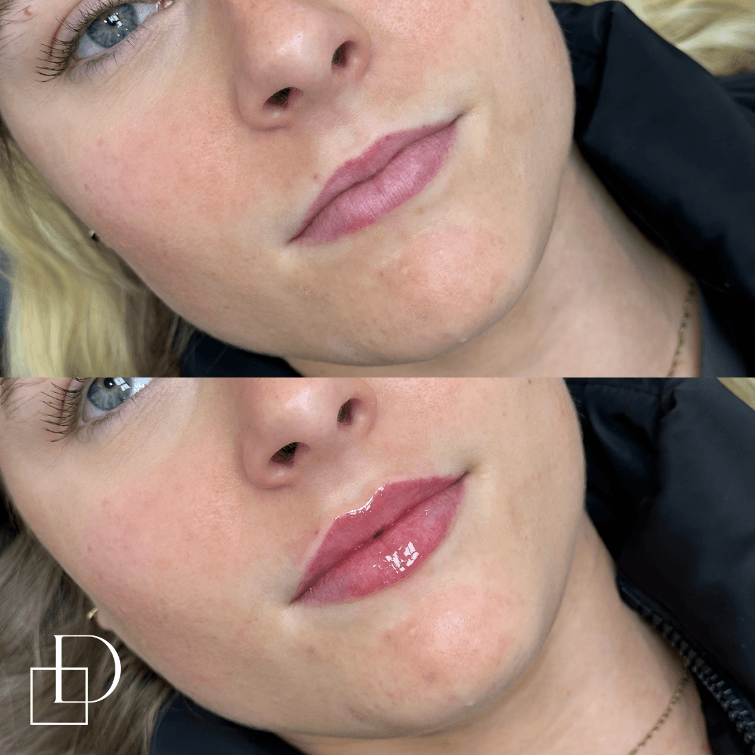 Before and after lip filler injections at Define Clinic Brisbane