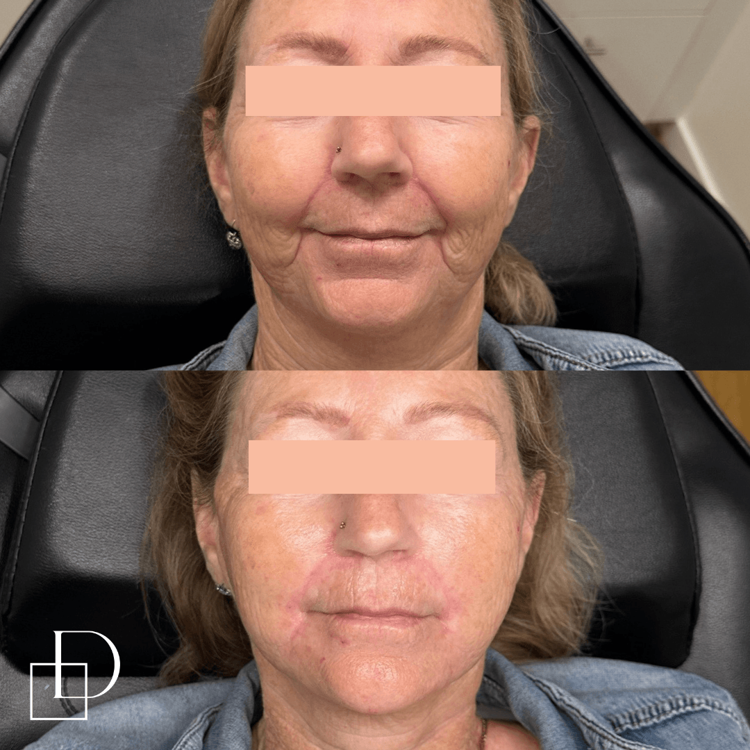 Before and after cosmetic dermal filler injections at Define Clinic Brisbane