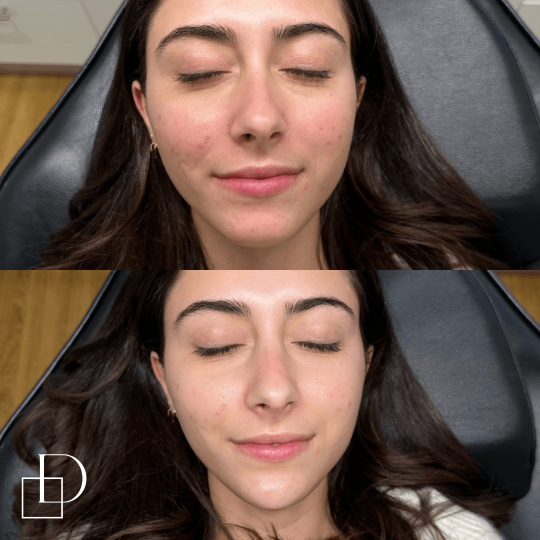 Before and after chin filler injections at Define Clinic Brisbane