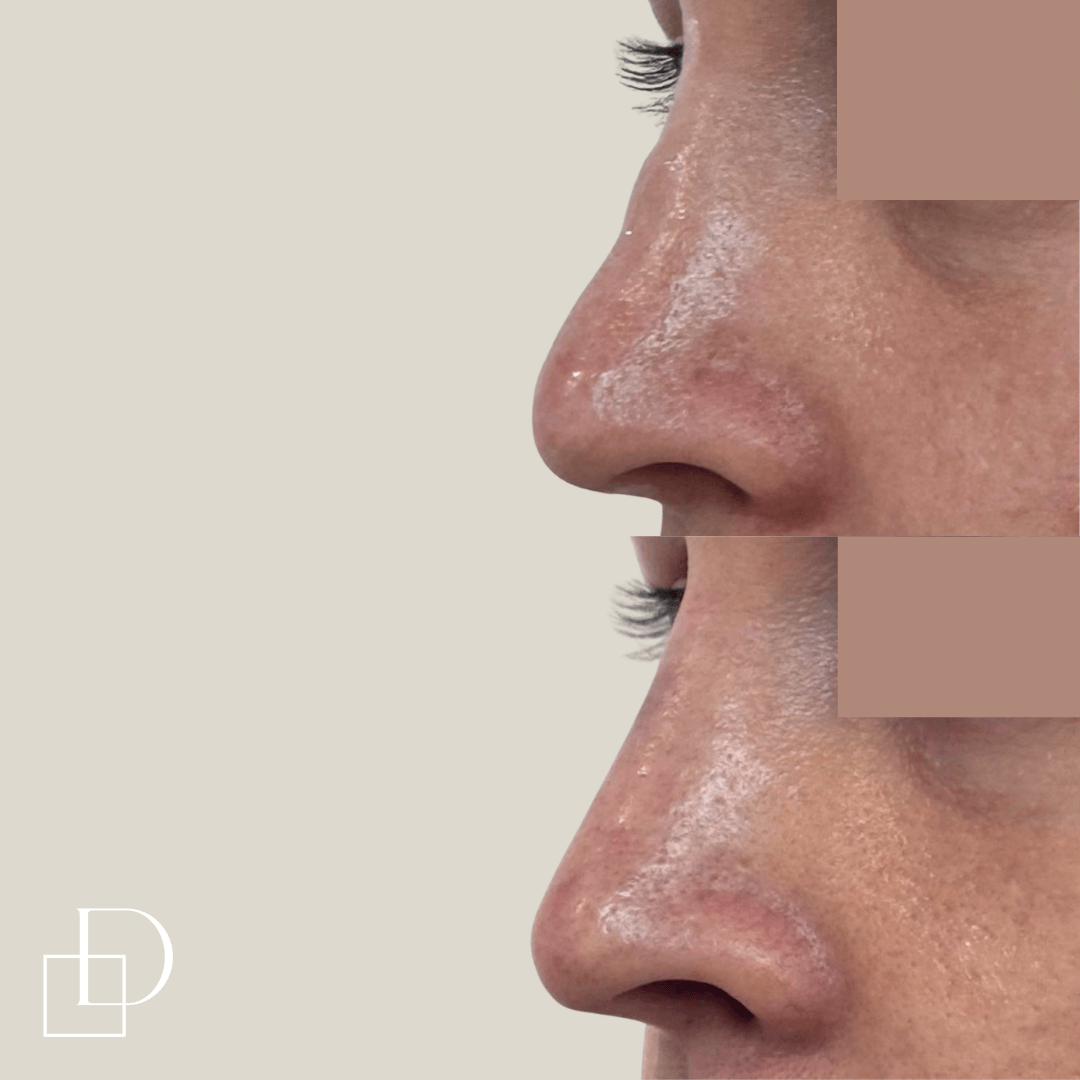 Before and after non-surgical rhinoplasty nose filler at Define Clinic Brisbane