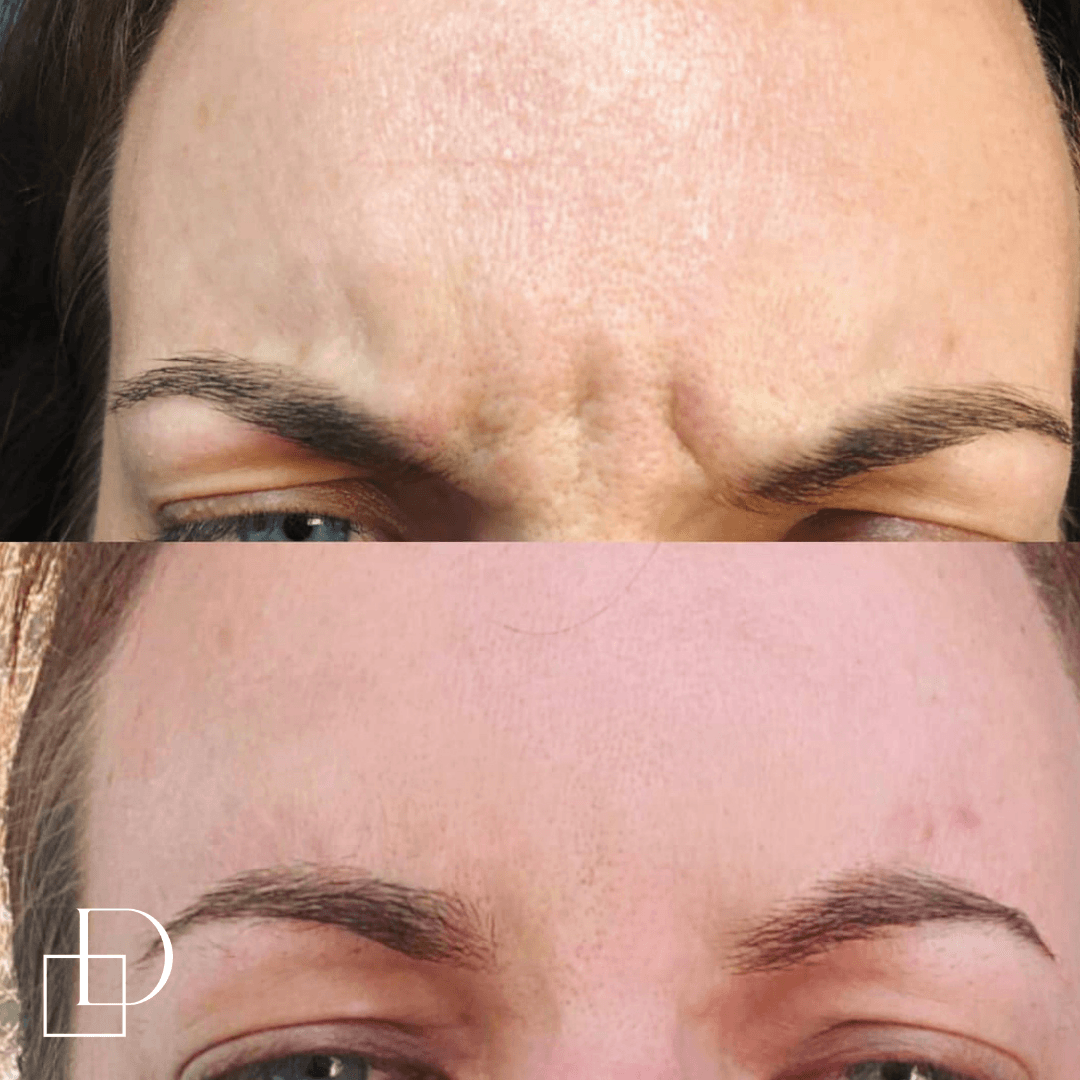 Before and after frown botox anti-wrinkle at Define Clinic Brisbane