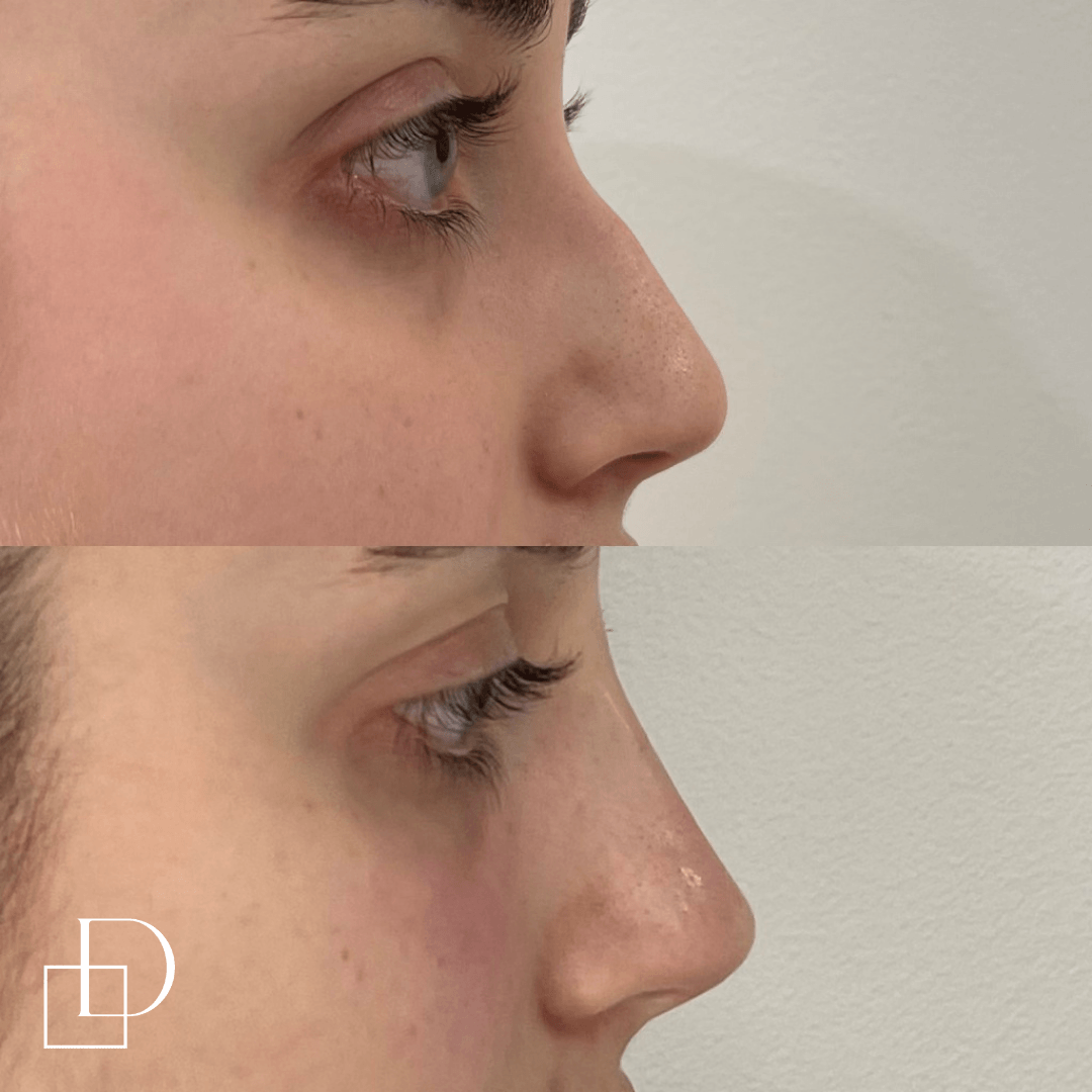 Before and after non-surgical rhinoplasty nose filler at Define Clinic Brisbane