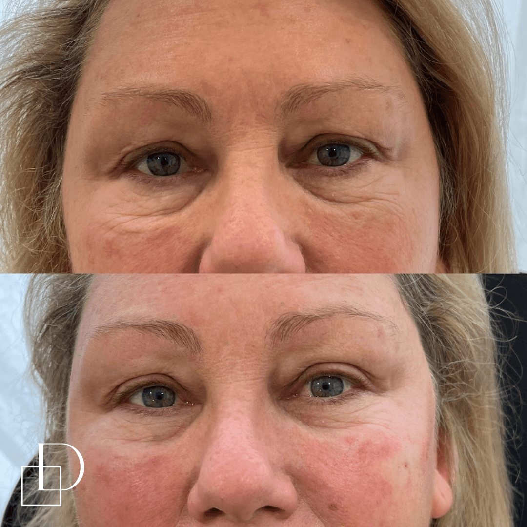 Before and after tear trough under eye filler injections at Define Clinic Brisbane