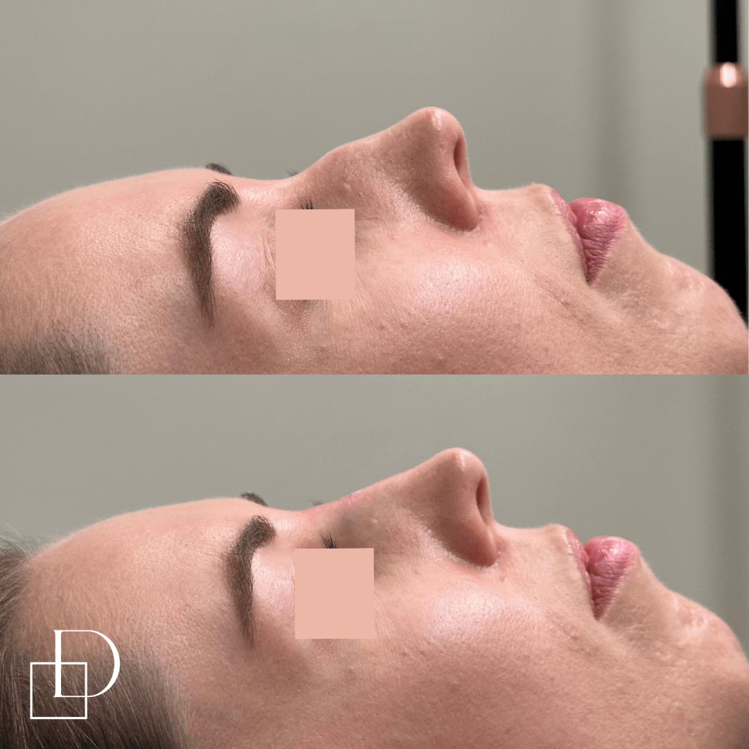 Before and after comparison of a woman's face showing improved skin texture and tone after a skincare procedure, with her eyes closed and head resting on her side.