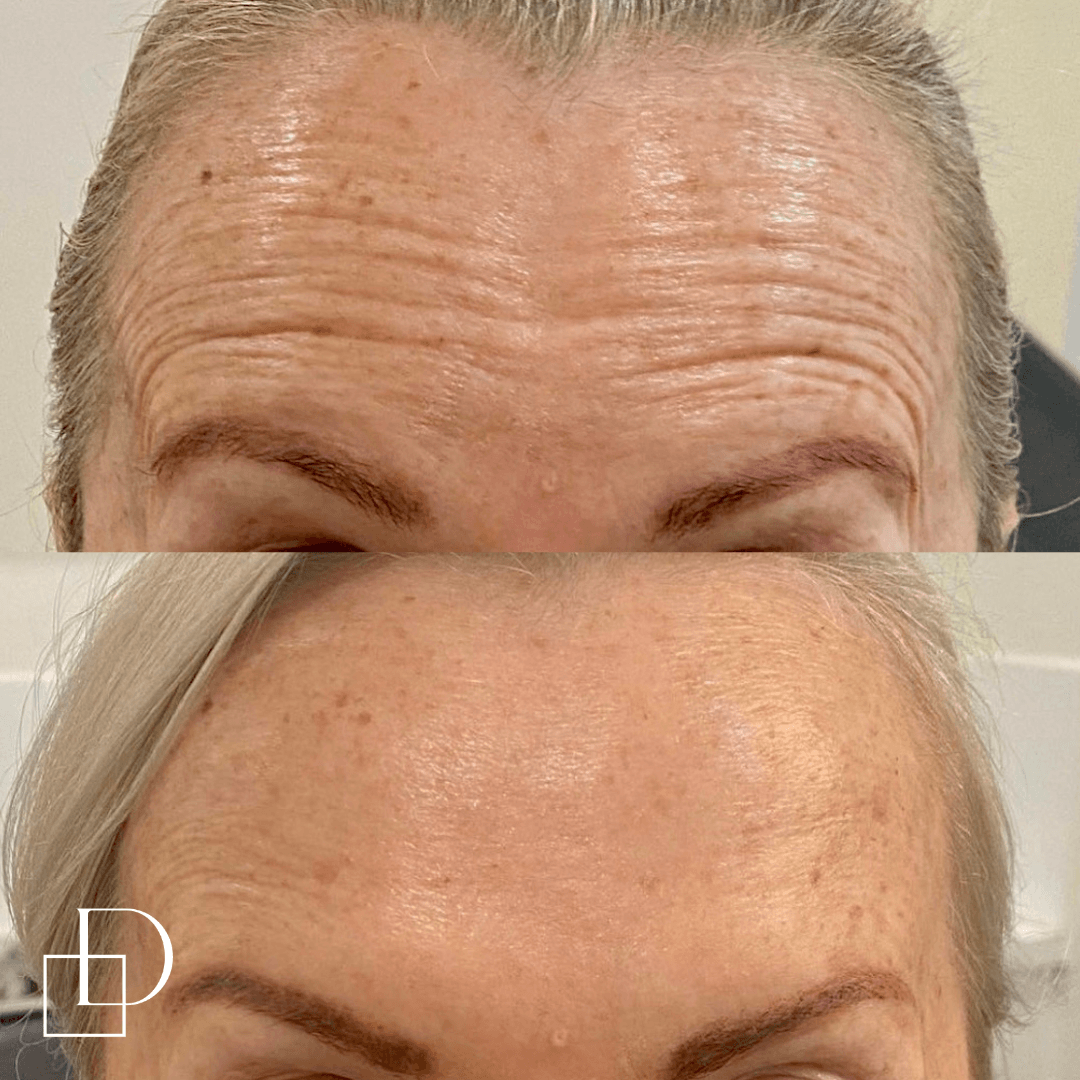 Before and after forehead botox anti-wrinkle at Define Clinic Brisbane