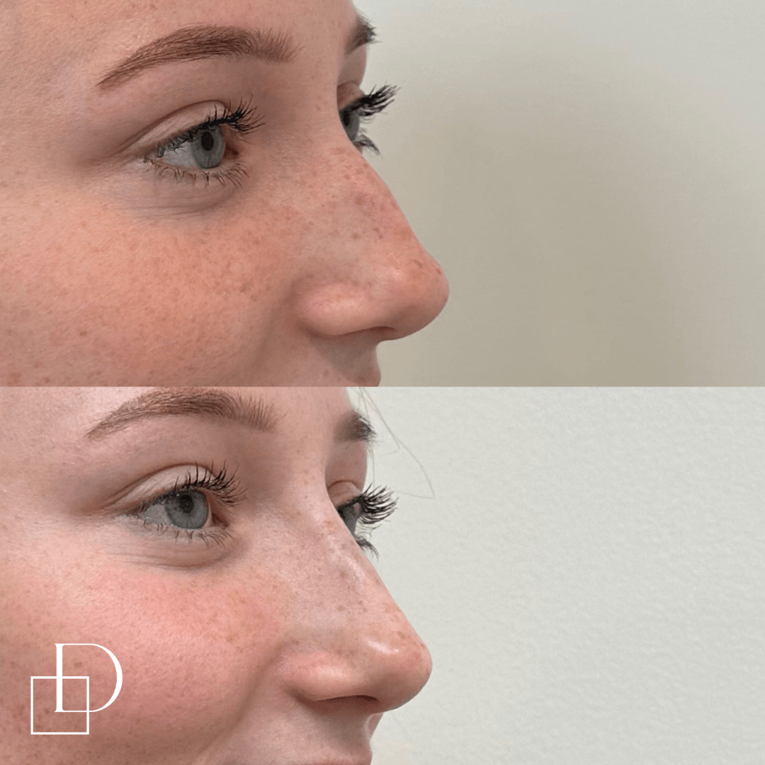 Before and after non-surgical rhinoplasty nose filler at Define Clinic Brisbane