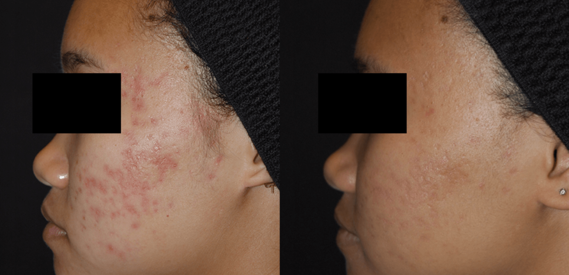 Before and after acne treatment with Laser Genesis at Define Clinic Brisbane