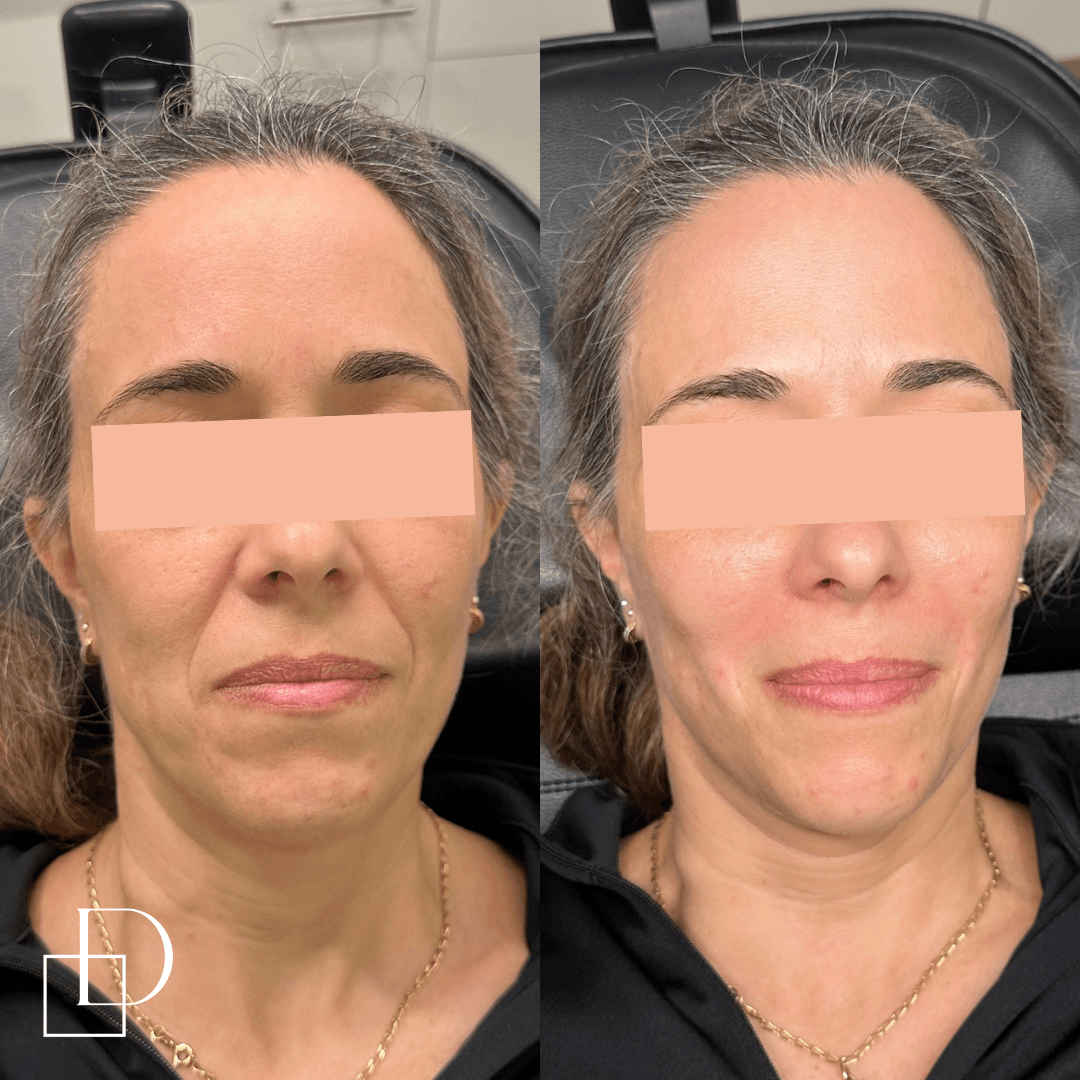 Before and after cosmetic dermal filler injections at Define Clinic Brisbane