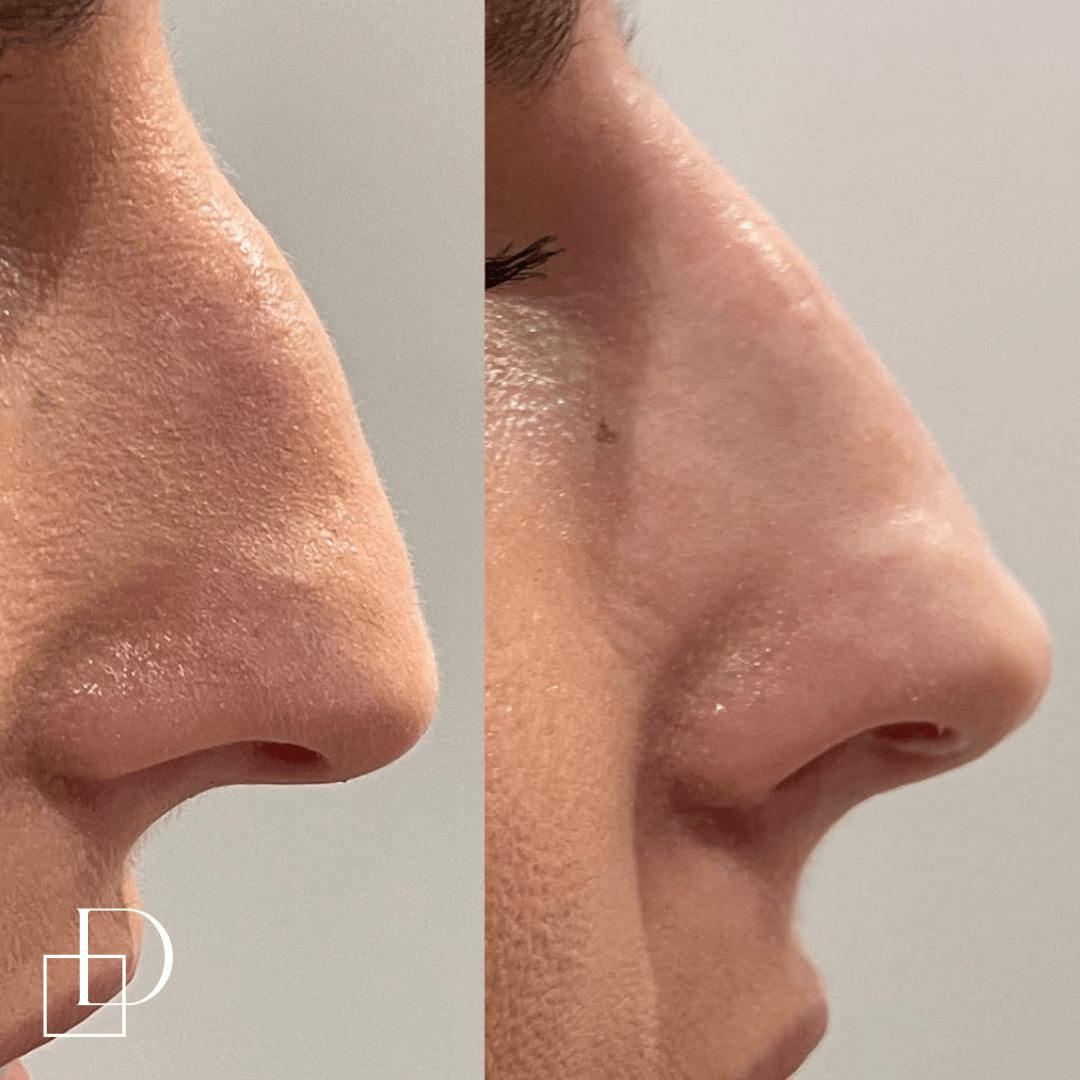Before and after non-surgical rhinoplasty nose filler at Define Clinic Brisbane