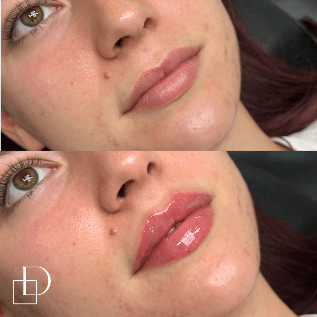 Before and after lip filler injections at Define Clinic Brisbane
