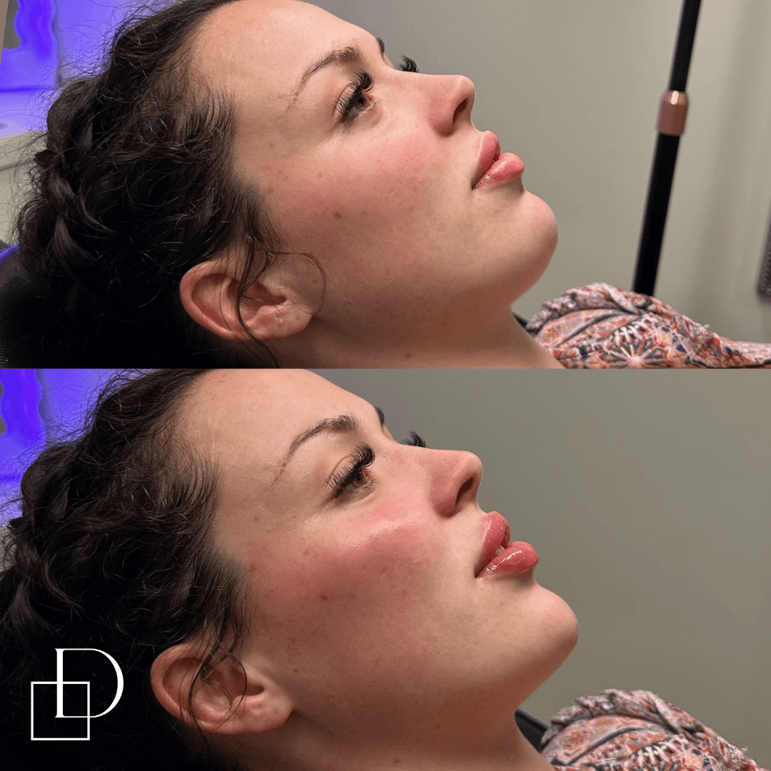 Before and after chin filler injections at Define Clinic Brisbane
