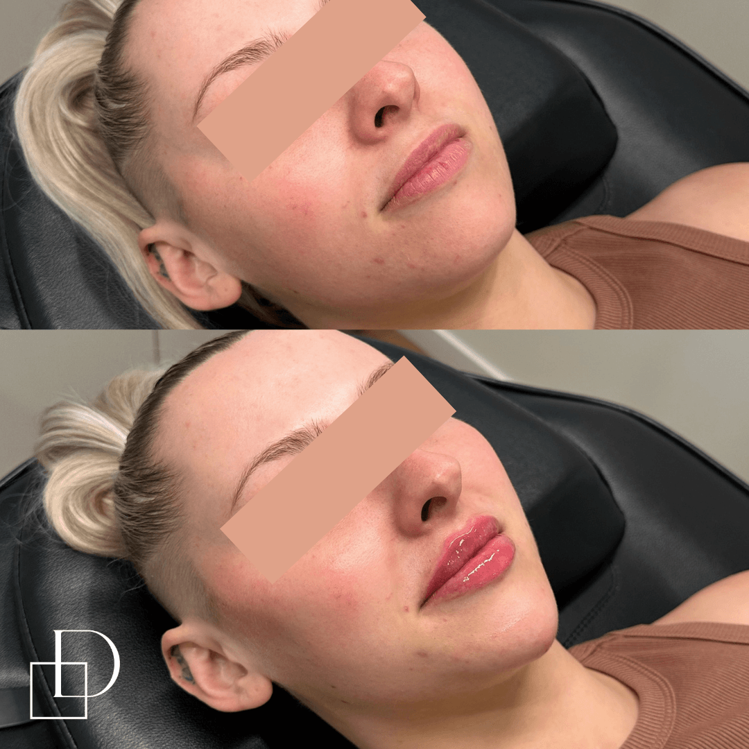 Before and after cosmetic dermal filler injections at Define Clinic Brisbane