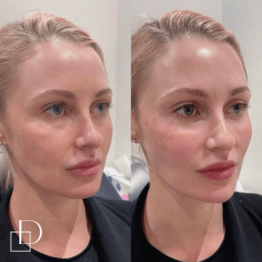 Before and after chin filler injections at Define Clinic Brisbane