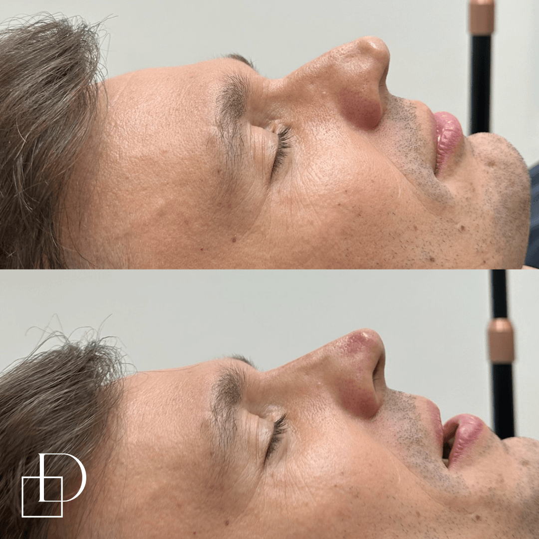 Before and after non-surgical rhinoplasty nose filler on male at Define Clinic Brisbane