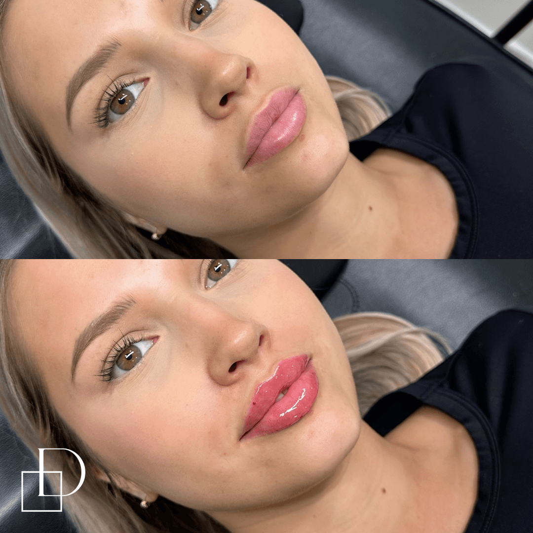 Before and after lip filler injections at Define Clinic Brisbane