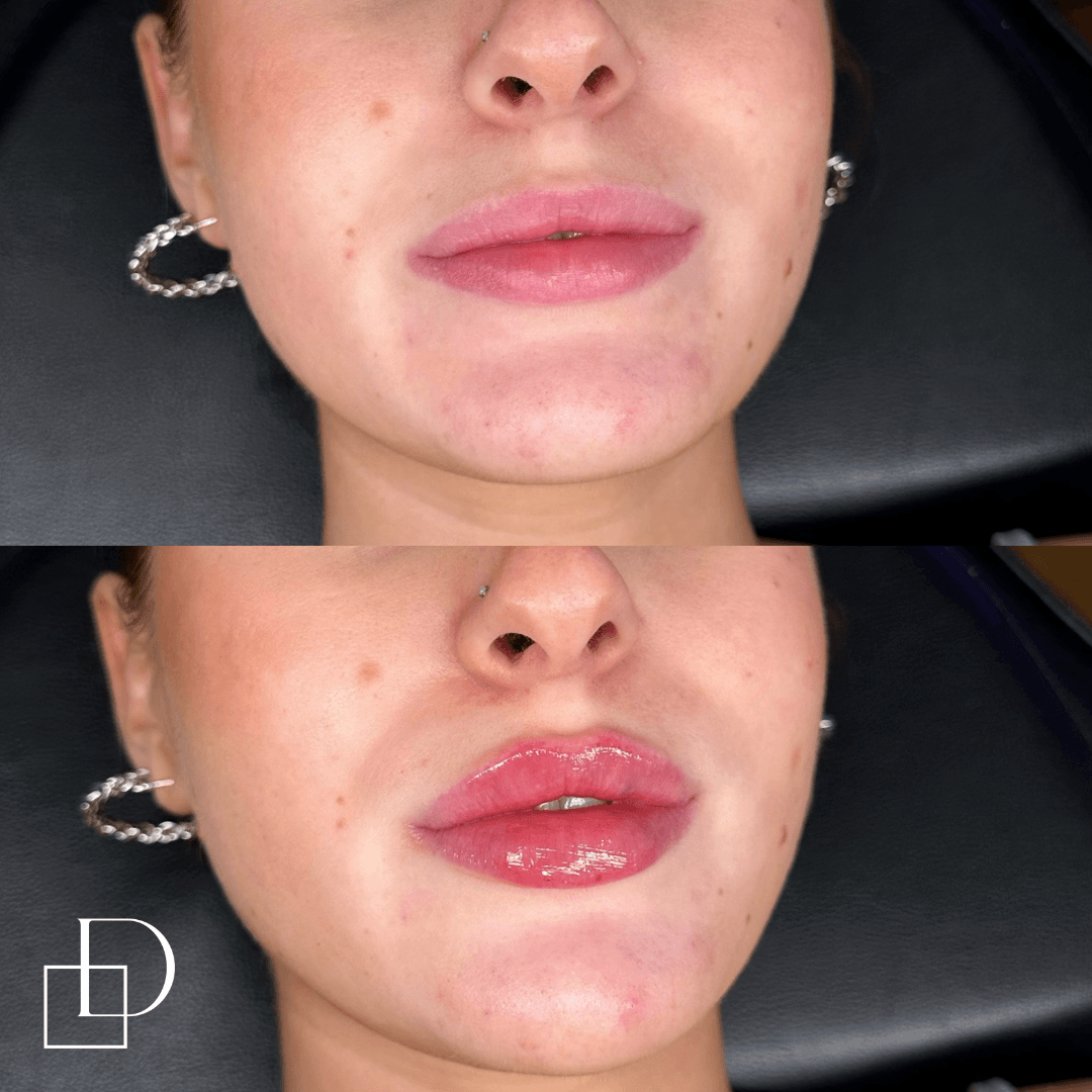 Before and after lip filler injections at Define Clinic Brisbane