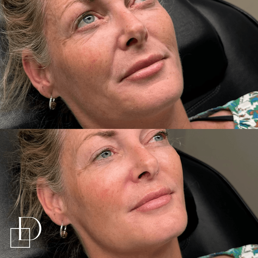 Before and after cosmetic dermal filler injections at Define Clinic Brisbane