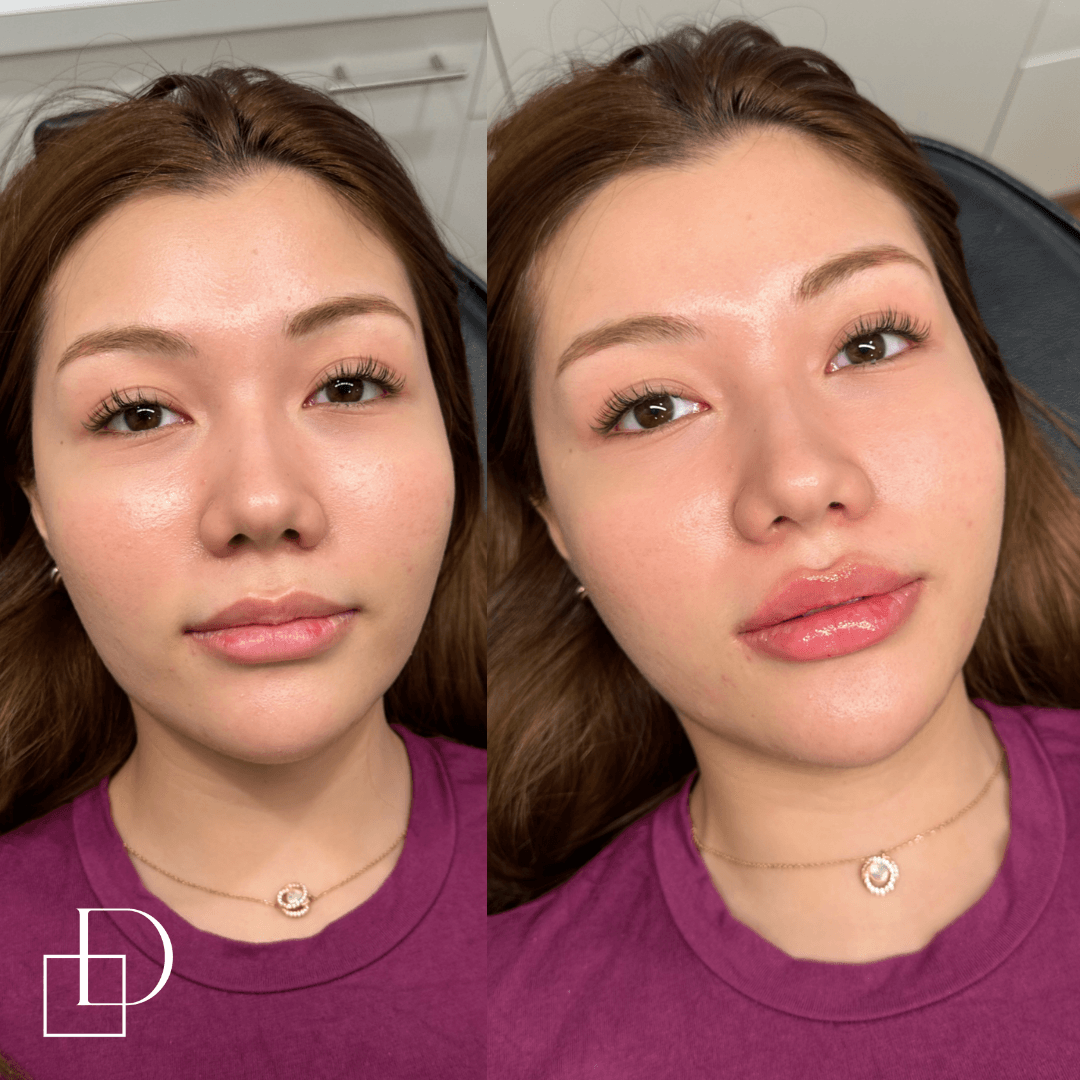 Before and after lip filler injections at Define Clinic Brisbane