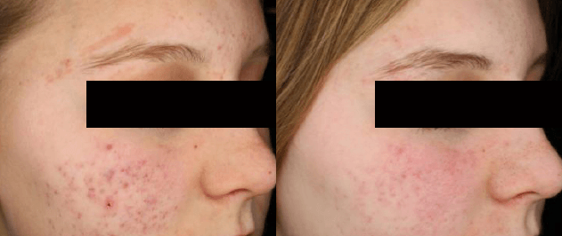 Before and after acne treatment with Laser Genesis at Define Clinic Brisbane