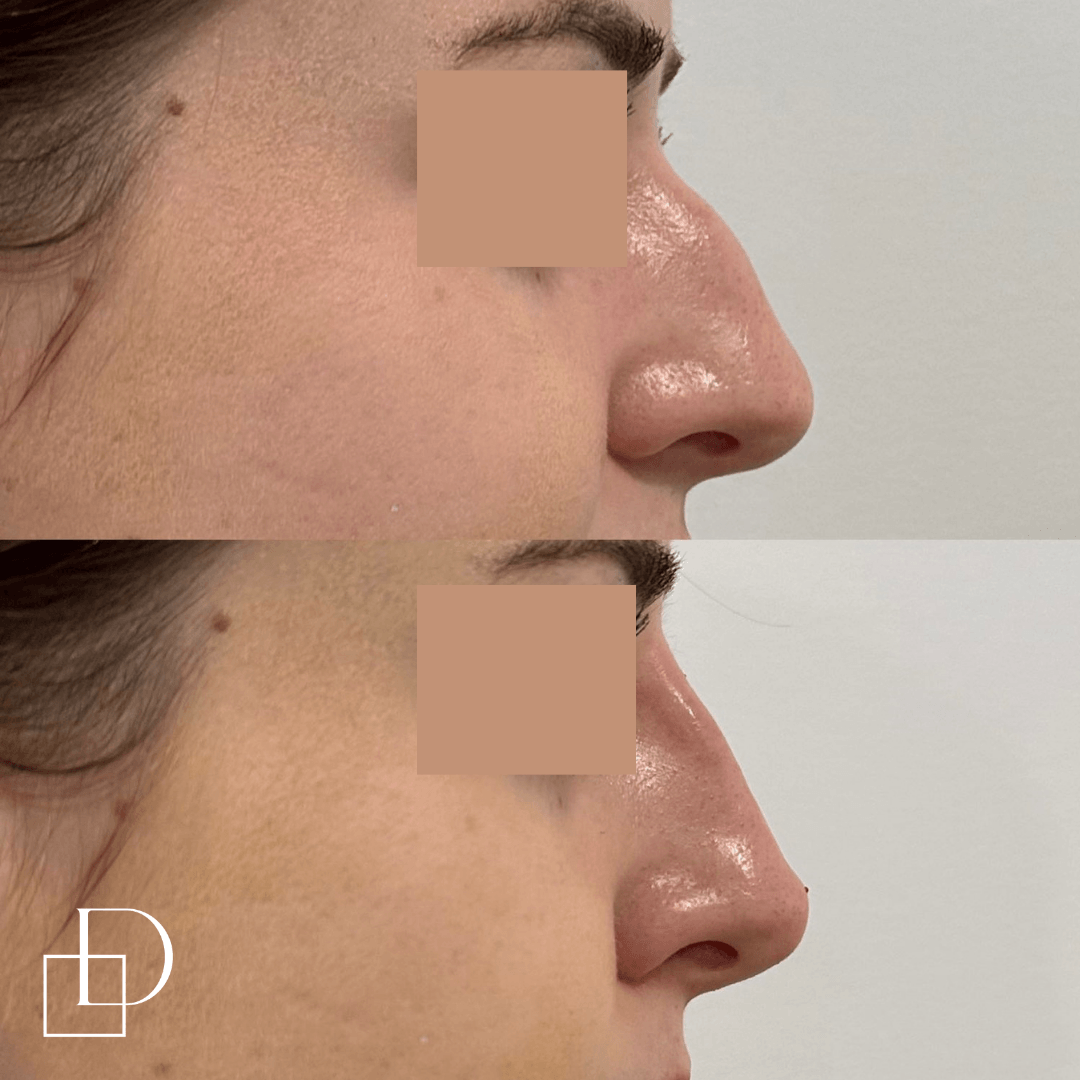 Before and after non-surgical rhinoplasty nose filler at Define Clinic Brisbane