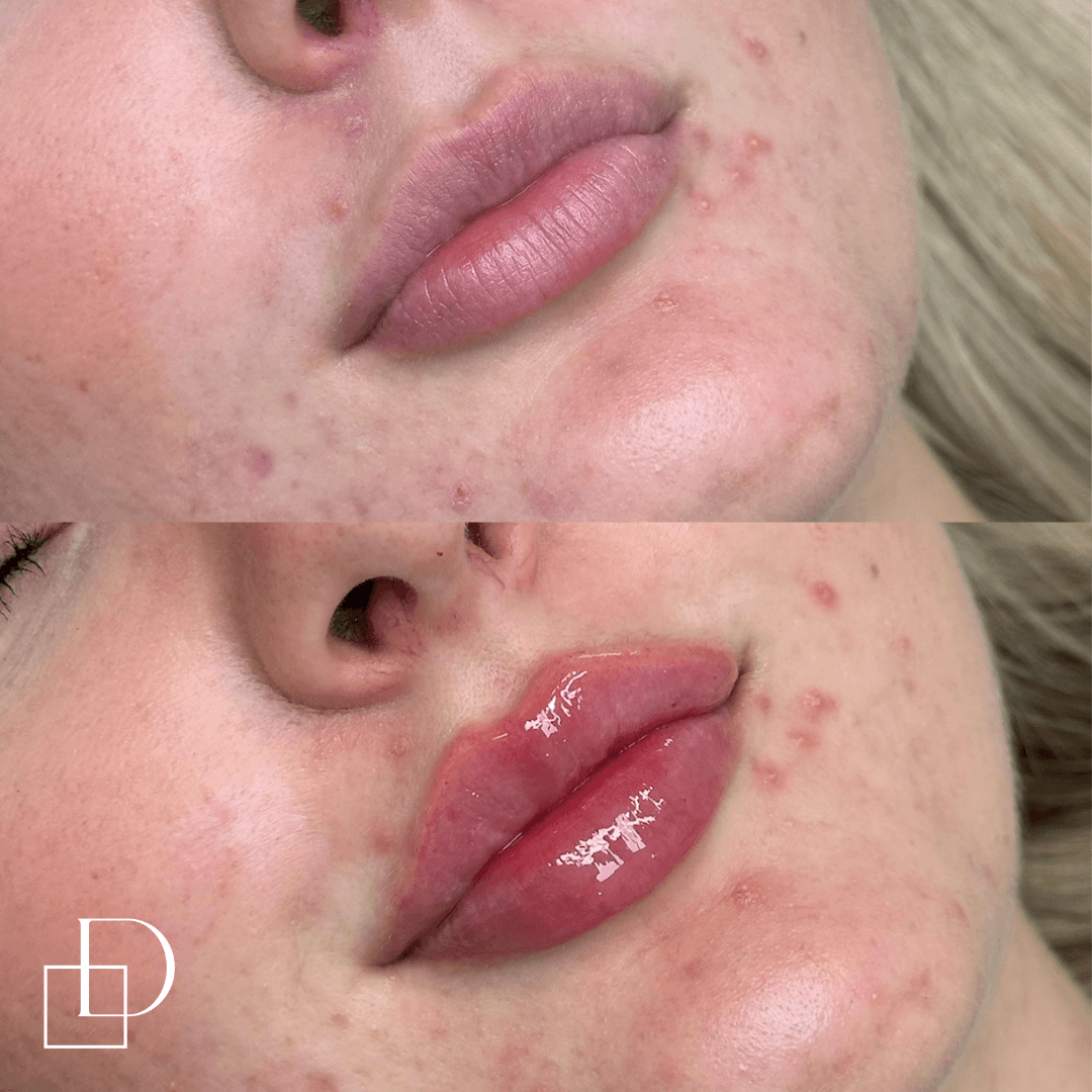 Before and after lip filler injections at Define Clinic Brisbane